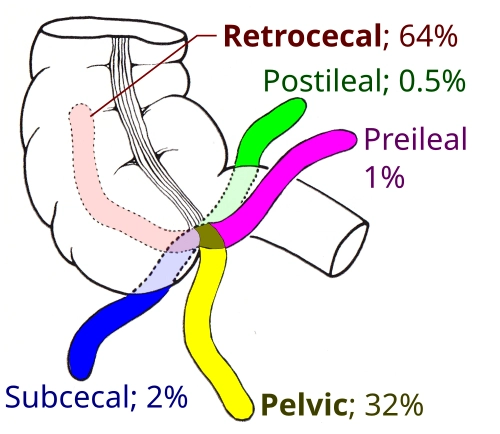 diagram showing different possible rotations of the appendix, with each showing a percentage associated with commonality.

Retrocecal is 64% and Postileal is 0.5%